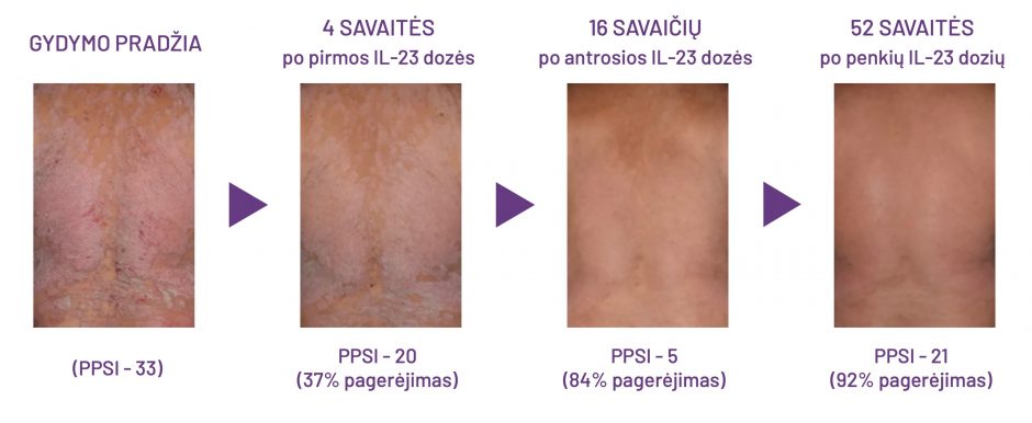 Klaipėdos universitetinėje ligoninėje – efektyvus psoriazės gydymas