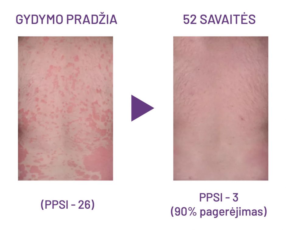 Klaipėdos universitetinėje ligoninėje – efektyvus psoriazės gydymas