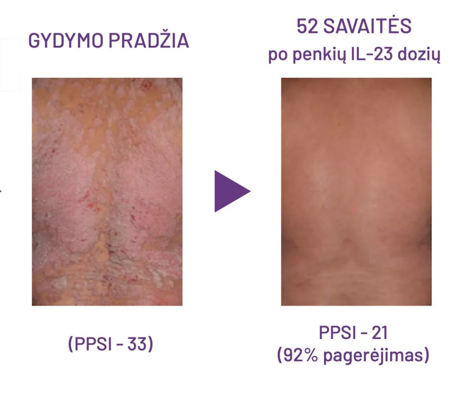 Klaipėdos universitetinėje ligoninėje – efektyvus psoriazės gydymas