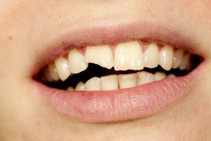 Nuskilo dantis? Padariniai – ne tik estetiniai